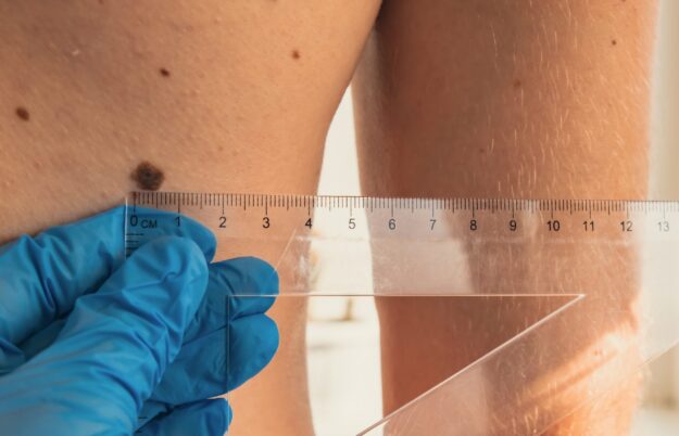 mappatura dei nei come si fa